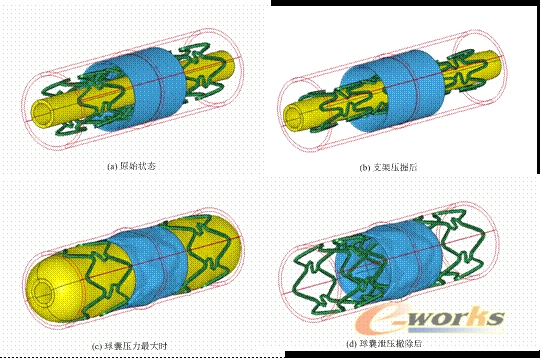 冠脉支架扩张过程数值模拟方法研究_CAE_产